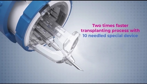 Multi-Implanter Hair Transplant Technique